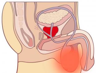 Seminoma testicular - um perigo oculto Seminoma clássico com sinais de invasão vascular linfática